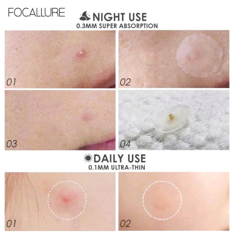 FOCALLURE Spot Patch Acne treatment Day/Night FA-186 BPOM Berkualitas