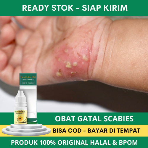 Obat Gatal Scabies, Obat Gatal Scabies Manusia, Obat Gatal Kulit Scabies Manusia, Obat Penghilang Sc