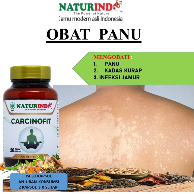 Obat Panu Gatal Gatal Eksim Panu Menahun