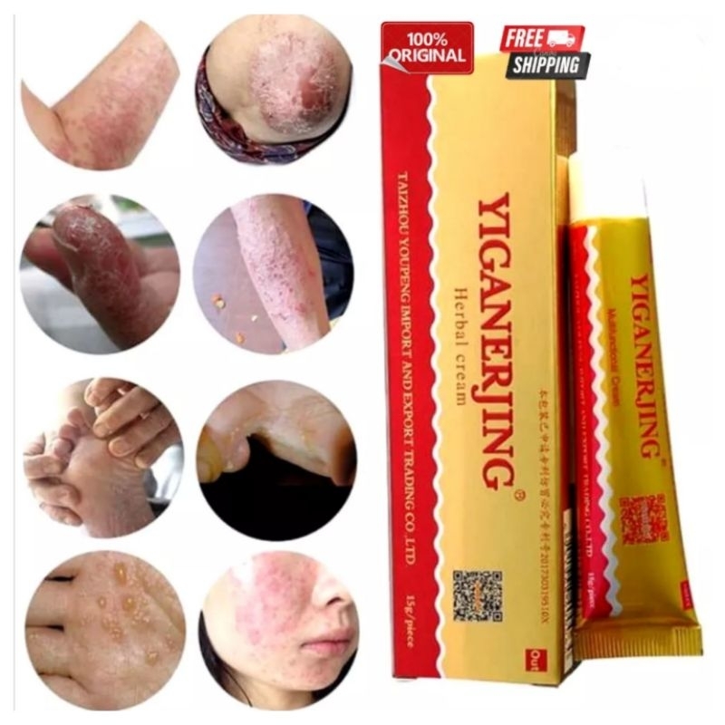 Salep Kulit YIGANERJING Eksim psoriaris dermatitis kulit gatal ruam alergi