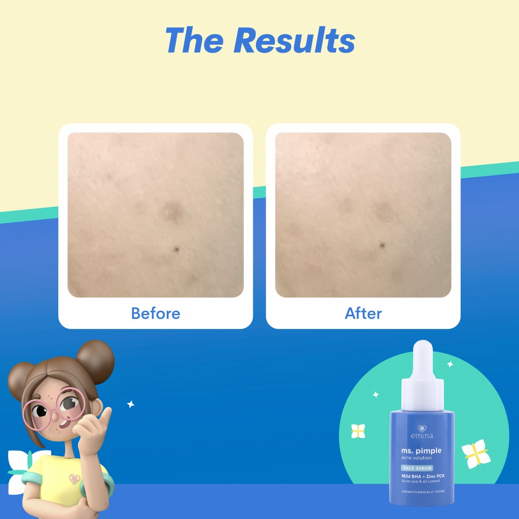 ✨ AKU MURAH ✨ Emina Ms. Pimple Acne Solution Face Serum 30 ml | Serum Wajah Solusi Atasi Jerawat [BPOM]