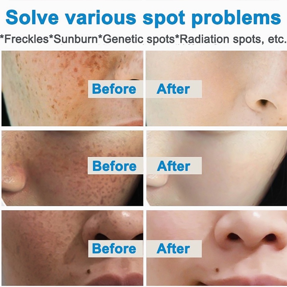 6-6 Youbuy Whitening Freckle Cream Remove Dark Spots Anti Freckle Cream Niacinamide Fade Pigmentation Melasma Brighten Creams