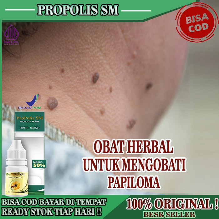 Obat Papiloma, Obat Oles Penghilang Papiloma, Obat Papiloma Di Leher / Di Badan, Perontok Daging Jad