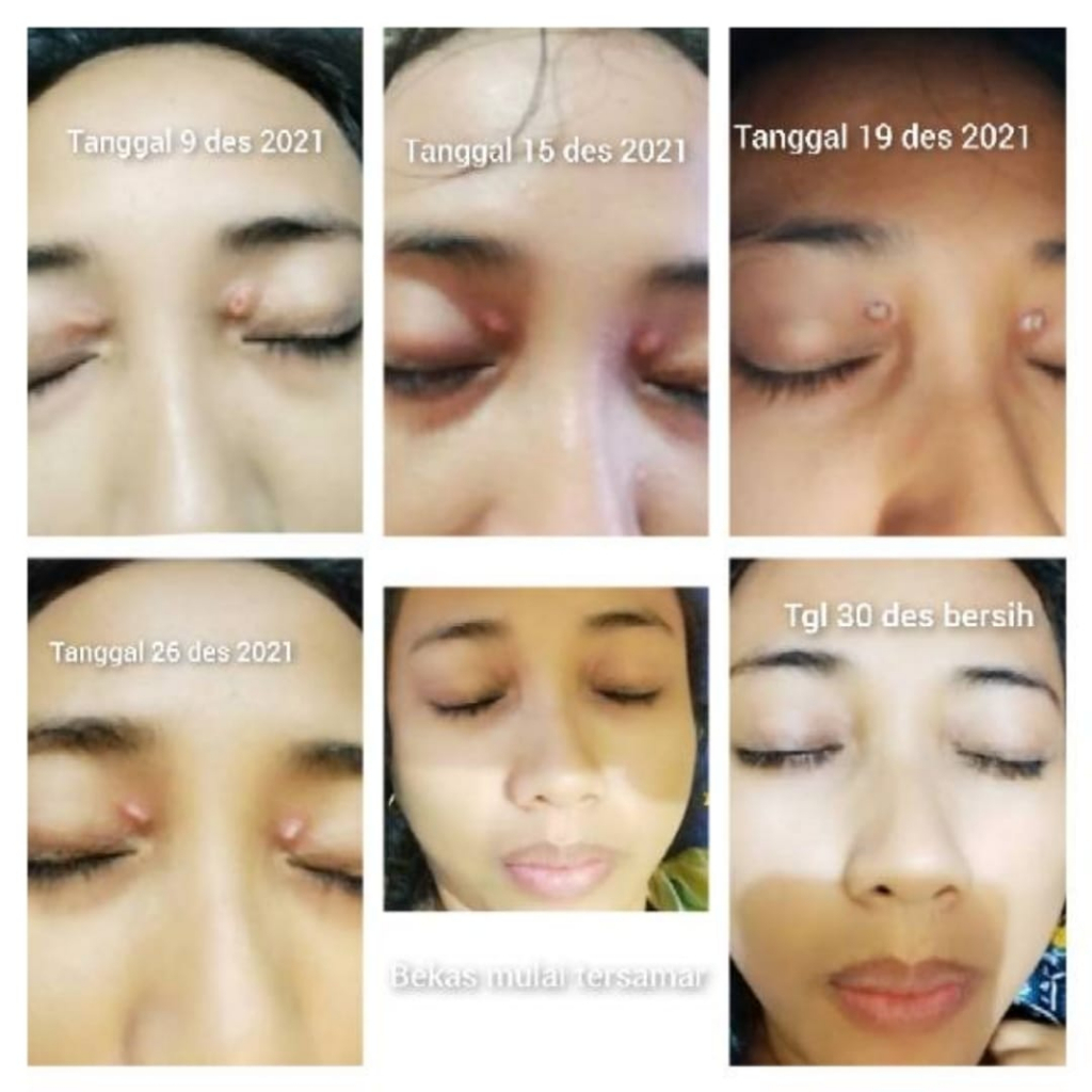 Paket Xanthelasma - Xanthelasma Cream 10 gram dan Xanthelasma Oil 5ml - obat oles dan salep untuk