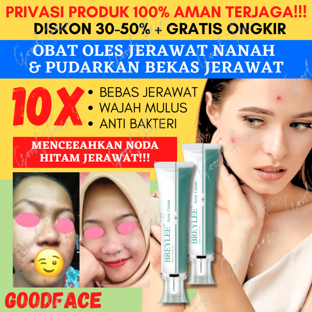 Penghilang Bekas Jerawat BREYLEE Acne Cream Scar Removal Penghilang Noda Bekas Jerawat, Luka &amp; Stretch Mark (30 g)