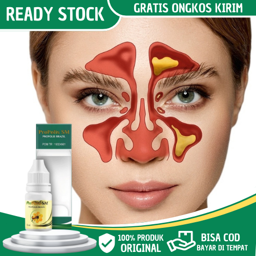Obat Sinusitis, Sinusitis Akut, Sinusitis Kronis, Pilek Menahun, Hidung Tersumbat, Flu Pilek Menahun