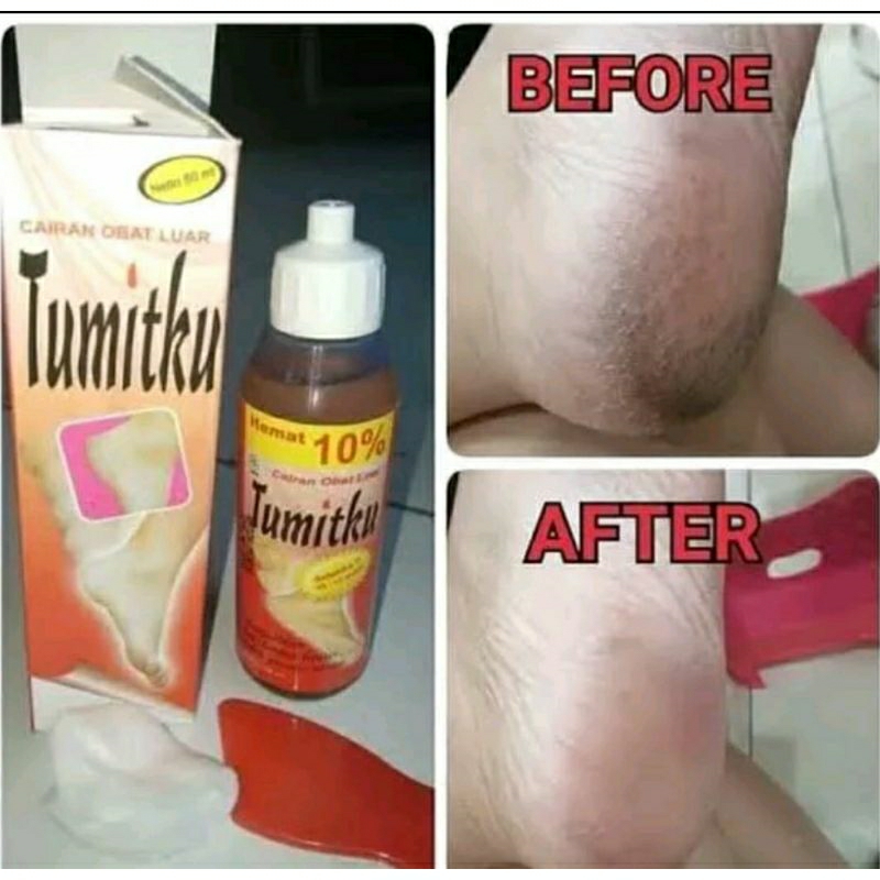 TUMITKU | MENGATASI KAKI PECAH&quot; &amp; KAPALAN | 30 ML