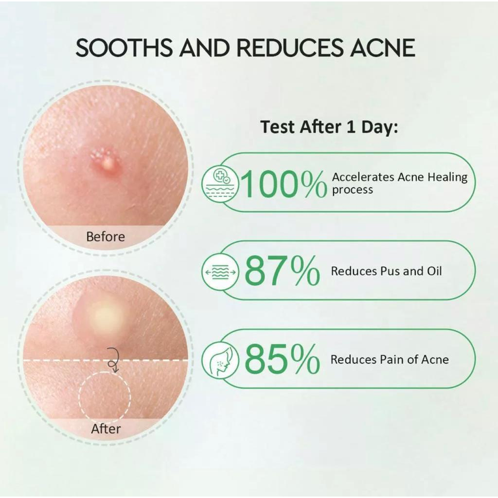 Glad2Glow Centella Salicylic Acid Night Acne Patch Pimple Patch Jerawat Stickers