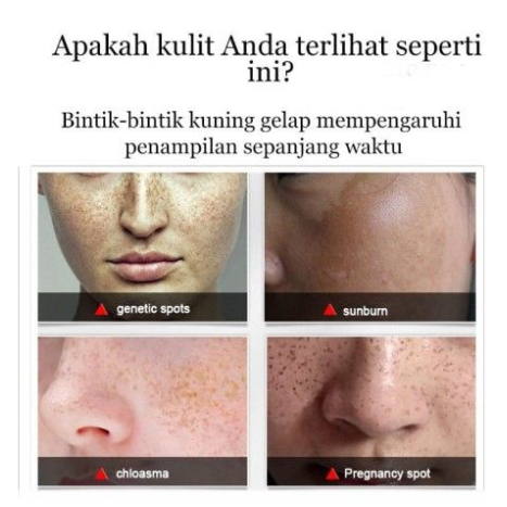 CINDYNAL Freckle Cream Remove Dark Spots Anti Freckle /Cream Niacinamide/Krim wajah penghilang flek hitam/Serum Wajah
