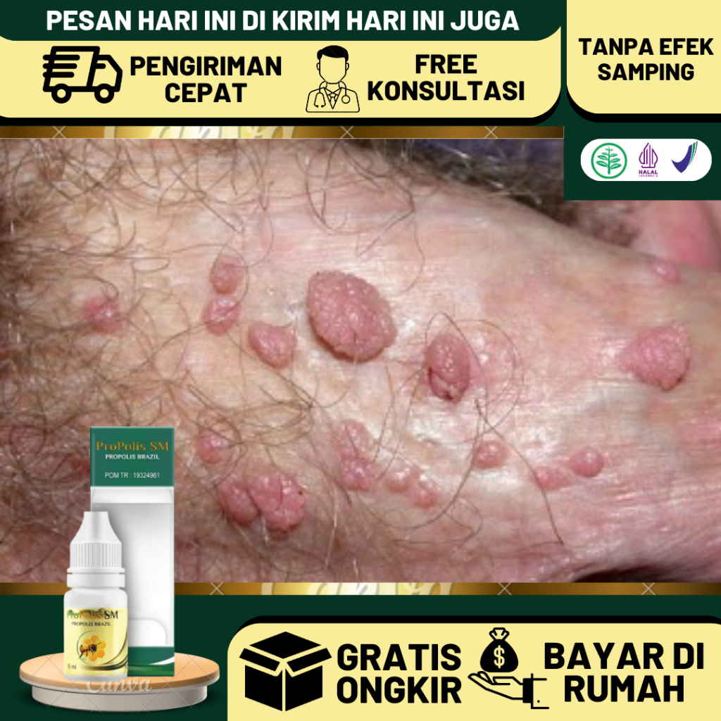 Obat Kutil Kelamin, Obat Perontok Kutil Kelamin, Obat Kutil Kelamin di Selangkangan Dan Kemaluan, Ob