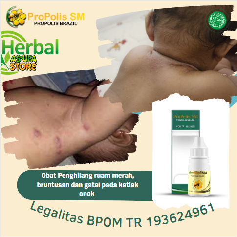 Obat Penghilang ruam merah, bruntusan dan gatal pada ketiak anak - dermatitis kontak alergi - dermat