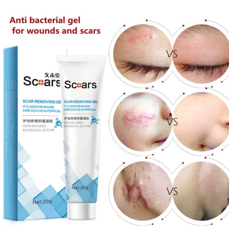 Scoars Gel Penghilang Bekas Luka, Gel Cedera Kulit, Gel Keloid