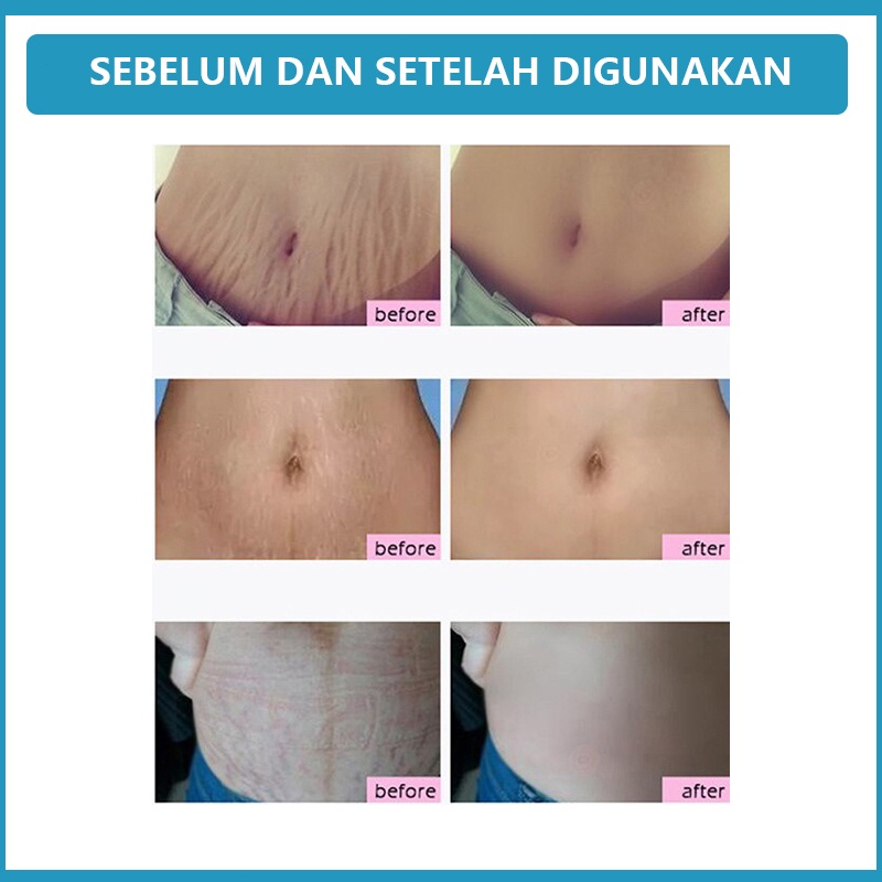 CREAM PENGHILANG STRETCH MARK Krim Stretch Mark 50G Penghilang Bekas Luka Penghilang Keloid Selulit Pregnancy Krim Anti Strechmark Aman untuk Bumil dan Busui