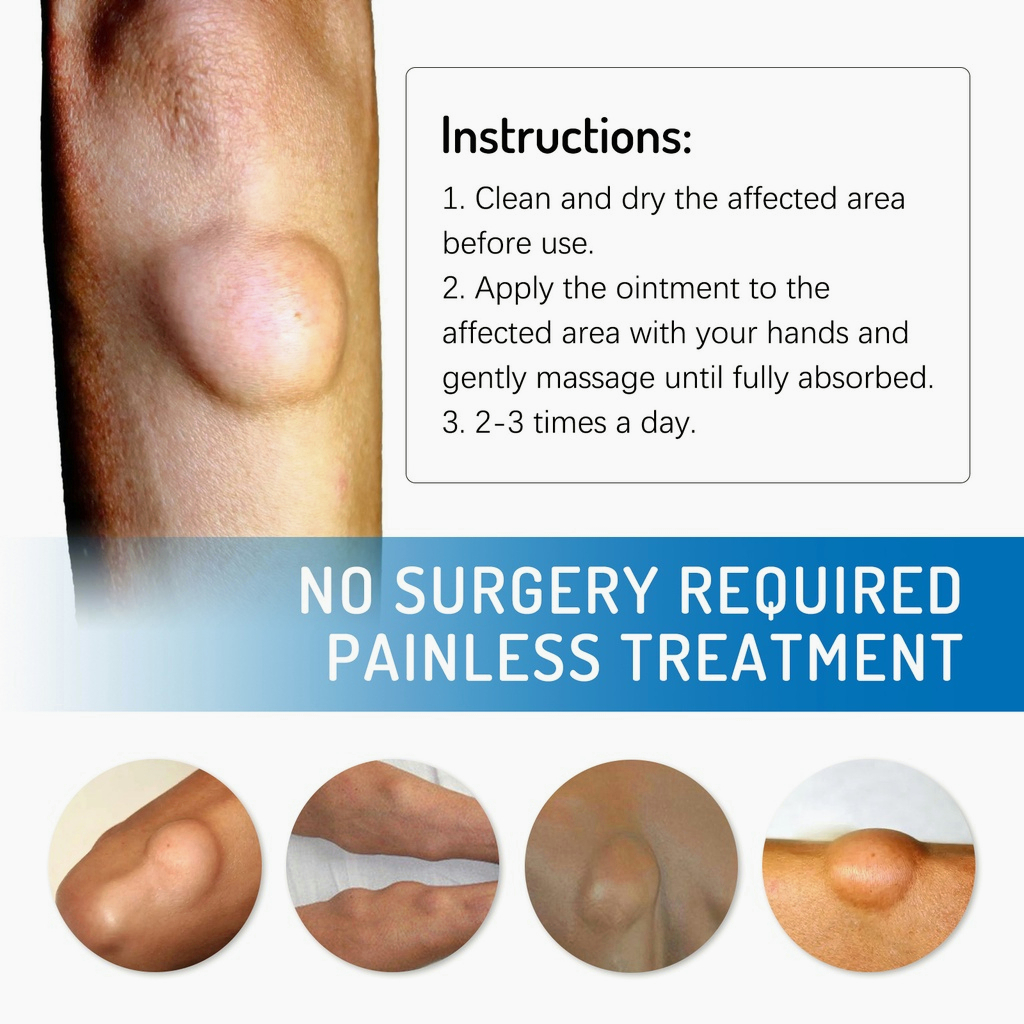 【ORIGINAL】Obat benjolan obat lipoma obat benjolan di leher 30g salep benjolan Obat Benjolan lipoma obat benjolan payudara Meredakan Benjolan Lipoma Luar Lemak Menghilangkan Tonjolan Benjolan Padat 100% asli