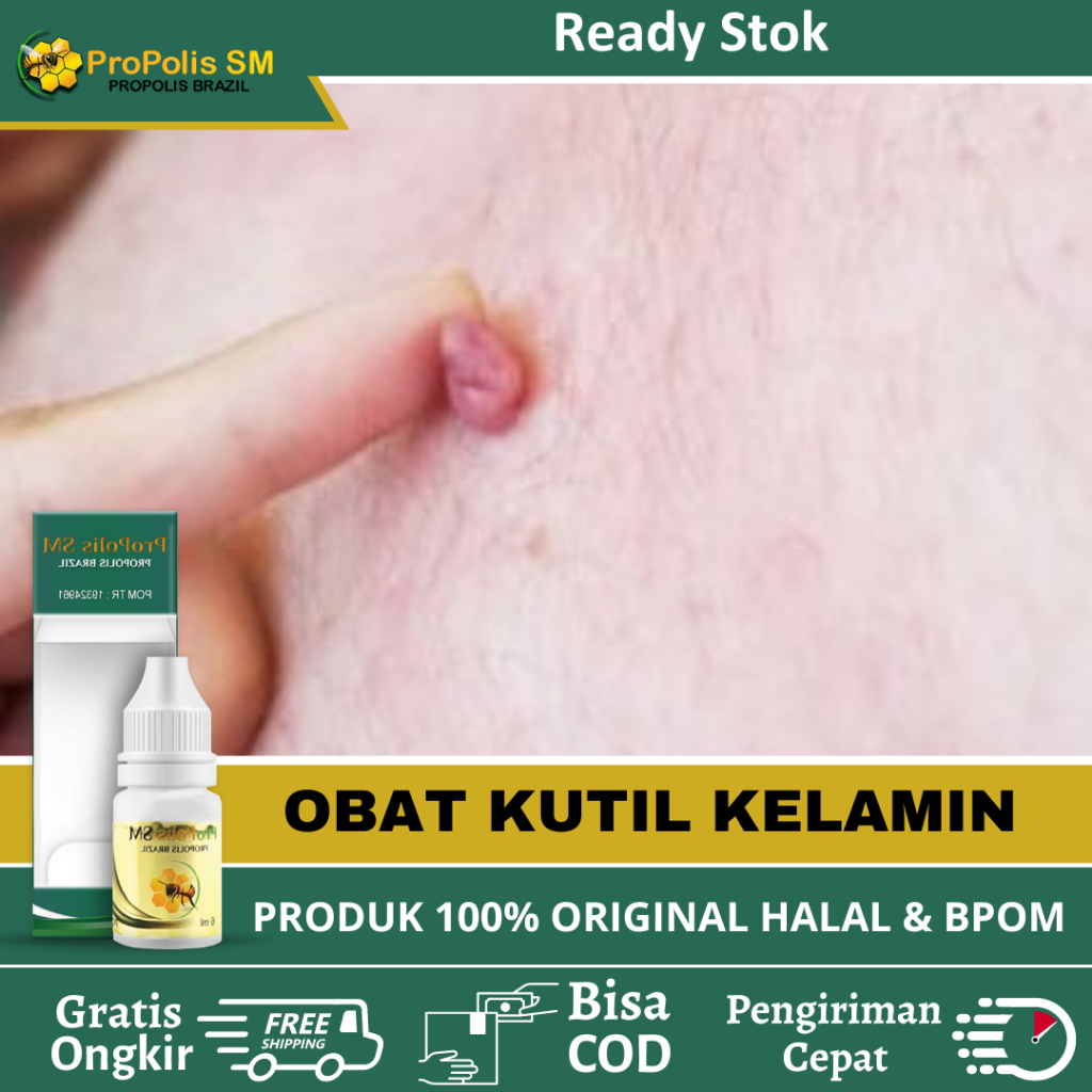 Obat Kutil Kelamin, Kutil Kelamin Pria, Kutil Kelamin Wanita, Perontok Kutil Kelamin Pria Dan Wanita