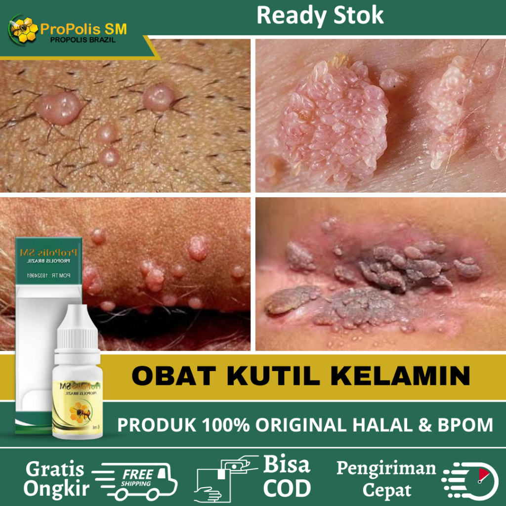 Obat Kutil Kelamin HPV, Obat Kutil Anus Pria / Wanita, Obat Perontok Kutil Kelamin Pria / Wanita, Ob