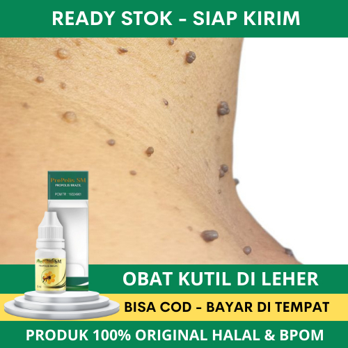 Obat Oles Perontok Kutil Di Leher - Obat Penghilang Kutil - Obat Kutil di Ketiak - Obat Kutil Di Leh