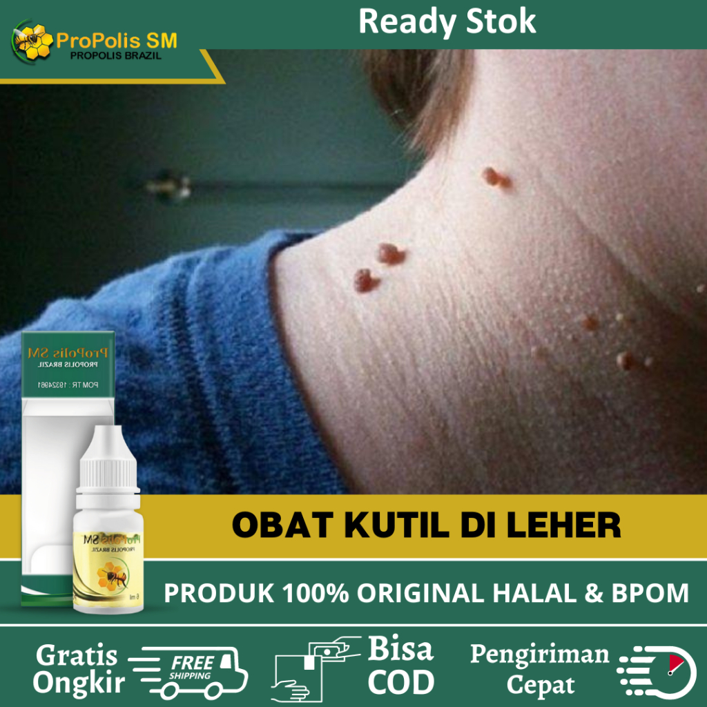 Obat Oles Perontok Kutil Di Leher - Salep Penghilang Kutil - Obat Kutil Di Leher - Obat Kutil Di Ket