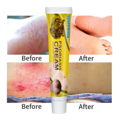 COD Psoriasis cream salep eczema dermatitis Itching Original