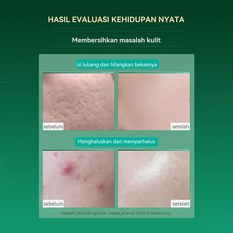 Esensi asam salisilat anti jerawat anti jerawat mencerahkan warna kulit kontrol minyak pemutih pelembab wajah cocok untuk semua jenis kulit esensi perawatan kulit 20ml