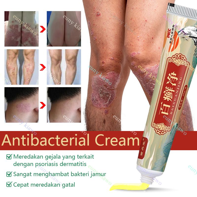 Obat Gatal Salep gatal Salep eksim Obat psoriasis Salep psoriasis 20G 【100% Original】Salep Kulit Jamur Dermatitis Psoriasis Eksim Jamur Kurap Alergi Kulit Cream Obat Gatal