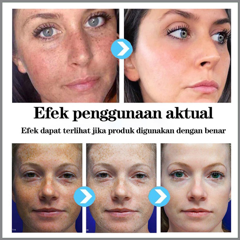 penghilang bintik hitam krim penghilang flek hitam cream penghilang flek hitam 4ml*20 Penghilang Melasma Krim Penghilang Bintik Pemutih Anti Penuaan Krim Penghilang Bintik Gelap