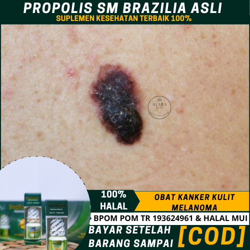 Obat Kanker Kulit, Obat Kanker Kulit Melanoma, Obat Oles Kanker Kulit Di Tangan Dan   Kaki, Obat Pen