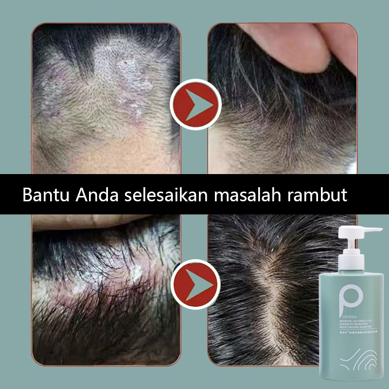 Anti-dandruff shampoo Sampo anti ketombe Shampo anti rontok Pengontrol minyak, anti-gatal, anti-ketombe, anti-penumpahan Bahan garam laut impor, penghilangan tungau 99%.Shampo anti ketombe dan anti gatal paling ampuh di Indonesia