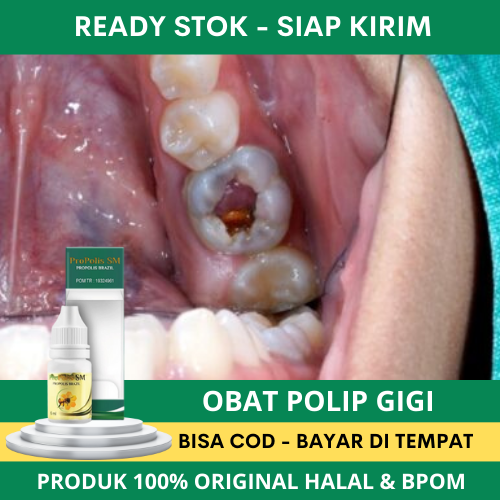 Obat Polip Pulpa Gigi - Polip Gigi - Nyeri Gusi - Gusi Bengkak - Gusi Berdarah - Gusi Bernanah - Pol
