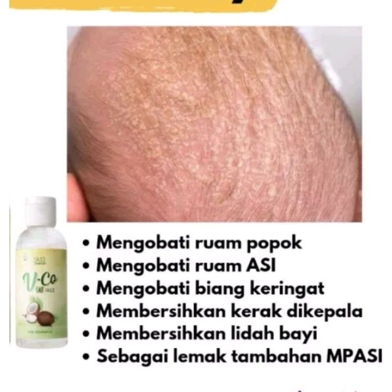 HAVANHA VICO BABY Obat Gatal - Biang Keringat - Ruam Popok - Cradle Crap - Alergi - VCO BAYI Virgin Coconut Oil Extrak Minyak Kelapa