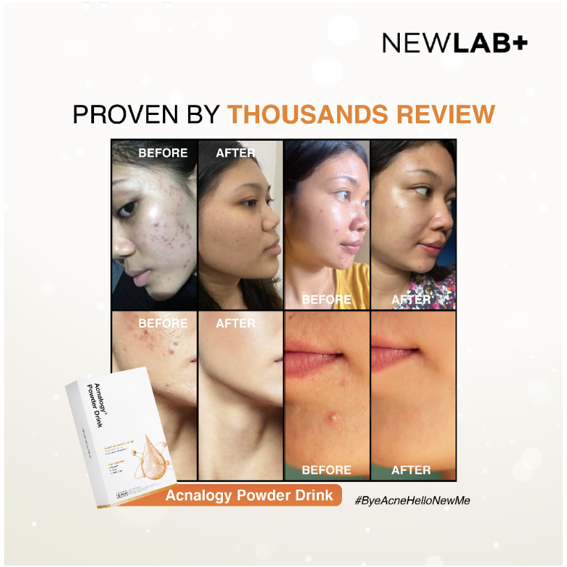 NEWLAB Acnalogy Powder Drink | Obat Minum Jerawat | Minuman Antioksidan | Penghilang Bekas Jerawat | Acne Treatment Drink