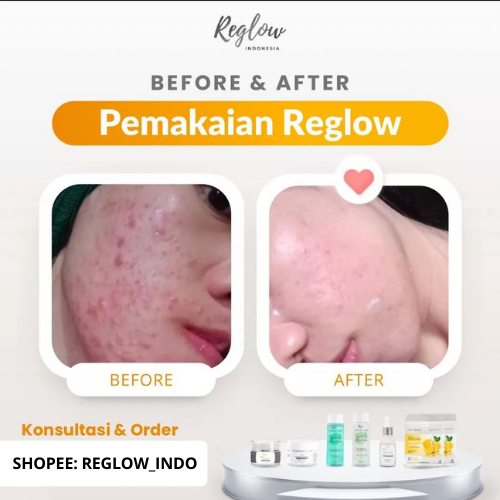 Reglow dr Shindy Putri Official Resmi Skincare Wajah Kusam Berjerawat Berminyak Bruntusan Penghilang Flek Hitam Komedo Milia Reg glow Original Shop