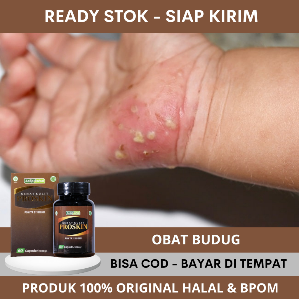 Obat Gatal Kulit Budug, Obat Budugan, Kulit Cenang Bernanah, Budug Bernanah, Jari Jari Cenang Bernan