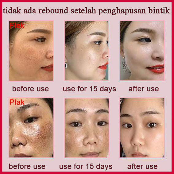 Penghilang Flek Hitam Di Wajah Night Whitening Salep Flek Hitam 20g Obat Cream Penghilang Flek Hitam/Bintik/Bekas Jerawat Membandel Original Pemutih Wajah