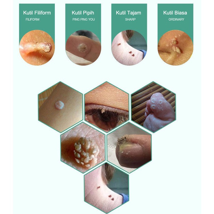 Krim kutil obat penghilang kutil penghilang kutil 20g skin tag remover Menghilangkan kutil, tahi lalat, berbagai skin tag di berbagai bagian tubuh