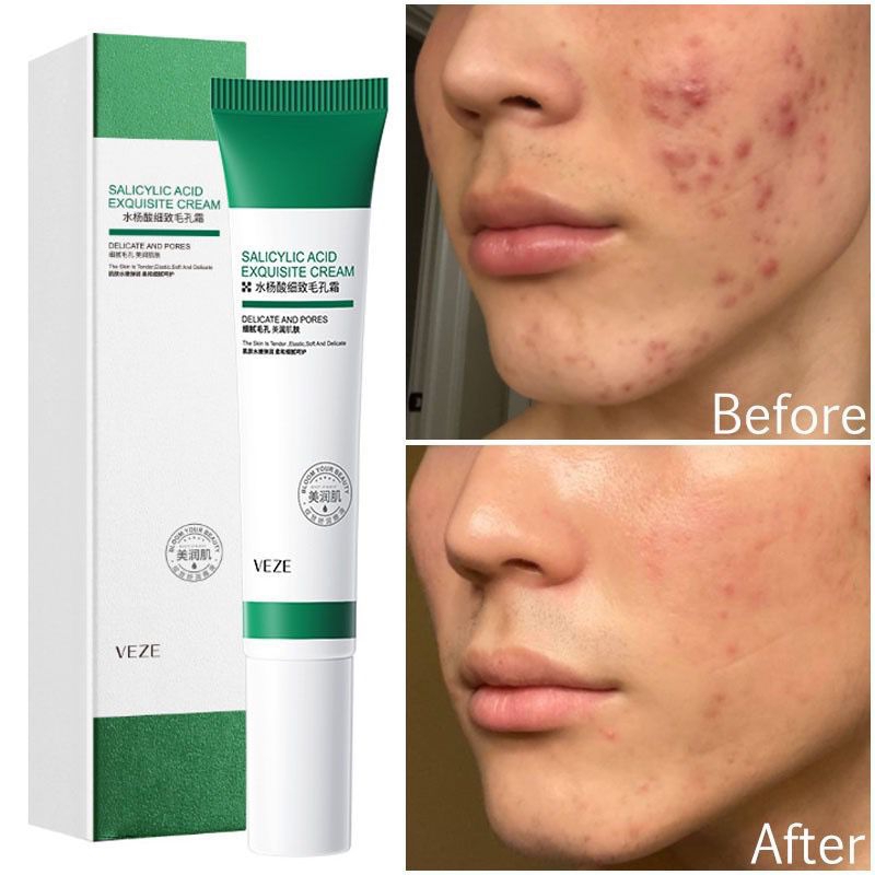 Veze SalicycidAcid Krim Penghalus Pori-pori Atasi  Jerawat Kontrol Minyak Anti penuan 20ml