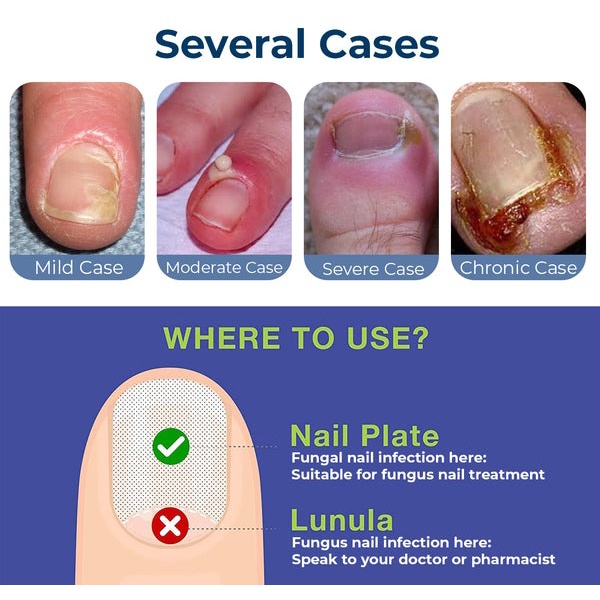 SUAI Ai Armor Guards Remove Ingrown Nail Essentl Oil Nail Groove Hair Paronychia Onychomycosis Tools