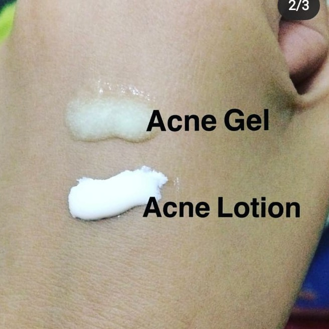 ⭐ BAGUS ⭐ Viva Acne Gel Triple Action 15g | Viva Acne Lotion 30 ml | Viva Whitening Cream 15g | Krim Jerawat
