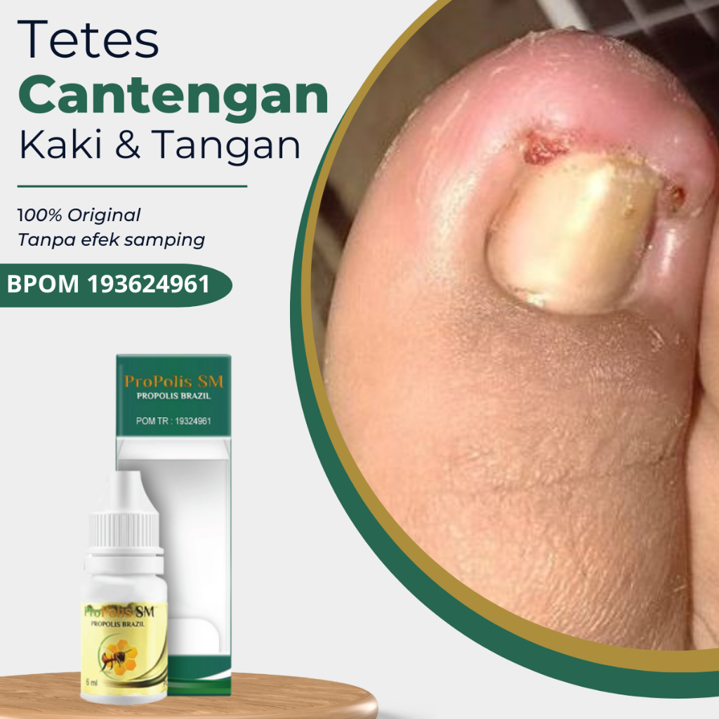 Propolis SM - Obat Kuku Jamur dan Rusak, Obat tetes Kuku Bengkak Bernanah Nyeri dan Bau Busuk, Obat 