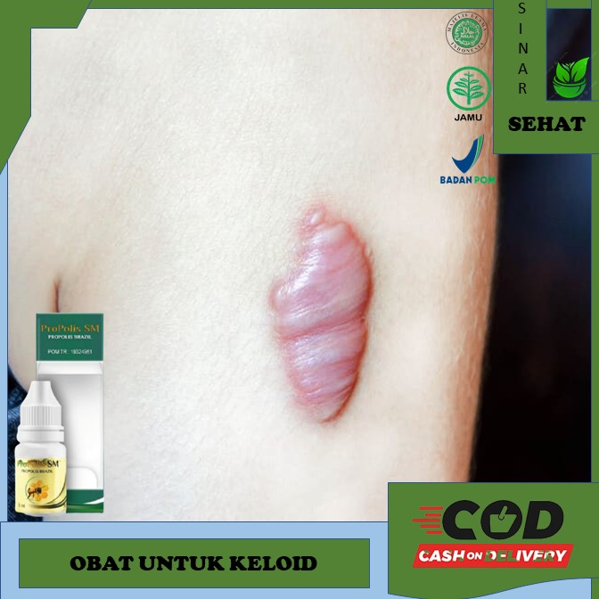 obat keloid  obat keloid menahun  Obat Penghilang Keloid Obat Keloid Daging Tumbuh - Penghilang Kelo