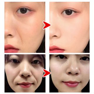 Tersedia Korea Microcrystalline Nasolabial Folds Anti-Wrinkle Patch Mata Anti Kerut Patch Lipatan nasolabial mikrokristalin Korea patch anti-kerut, penutup mata anti-kerut, patch dahi anti-kerut