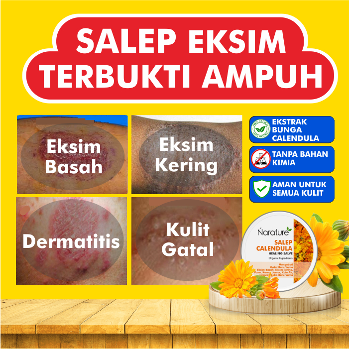 Salep Obat Eksim Calendula Salve Kering Basah Menahun Paling Ampuh Gatal Gatel Exim Kulit Kutu Air S