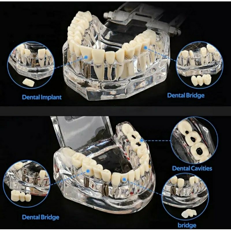 Dental Model gigi Study transparan Crown bridge caries implan / phantom gigi belajar