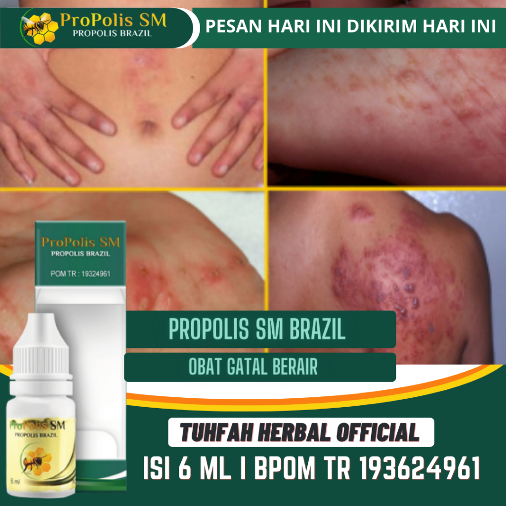 Obat Gatal Berair Kulit, Obat Gatal Kulit, Obat Gatal Berair Di Jari Tangan Dan Kaki, Obat Gatal Di 