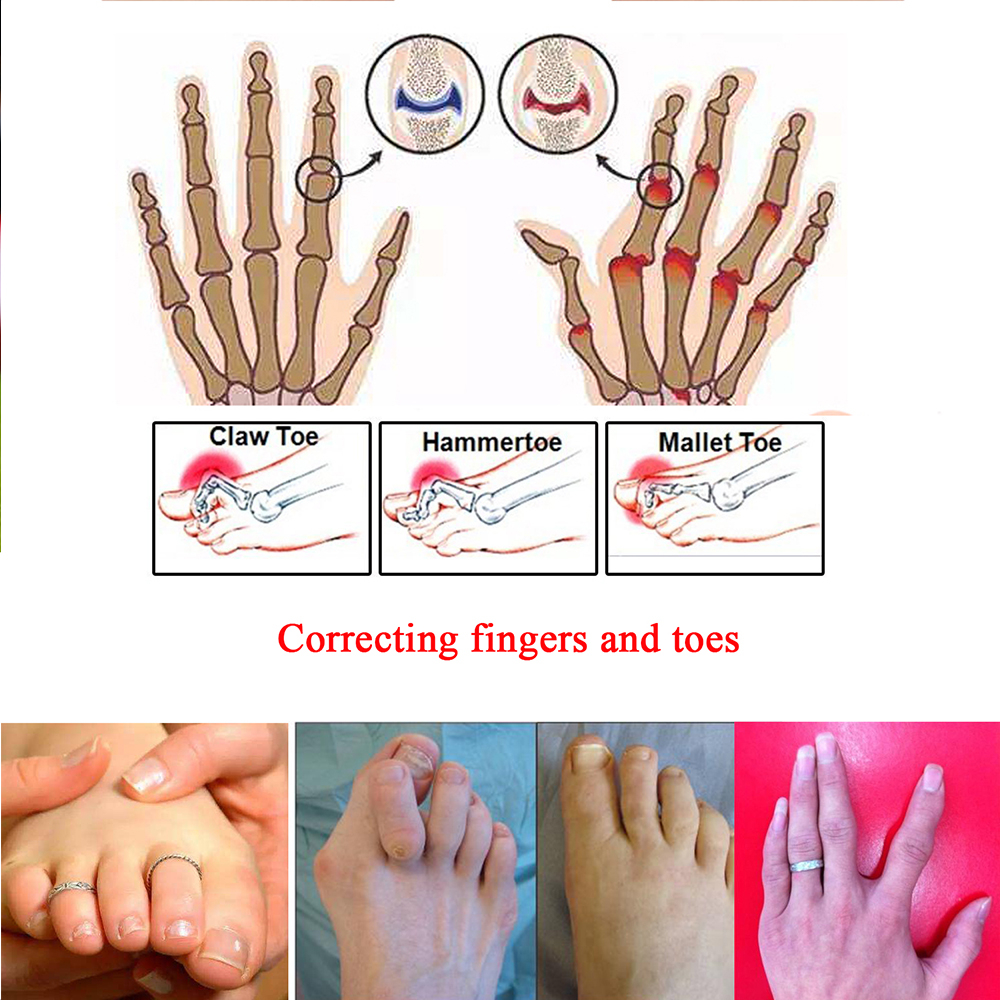 [BAYAR DI TEMPAT] 6 Pcs Pemisah Jari Tangan Kaki / Pelindung Jari Kaki Tangan / Hallux Valgus Bunion Separator Bandage / Perban Pemisah Jari Kaki