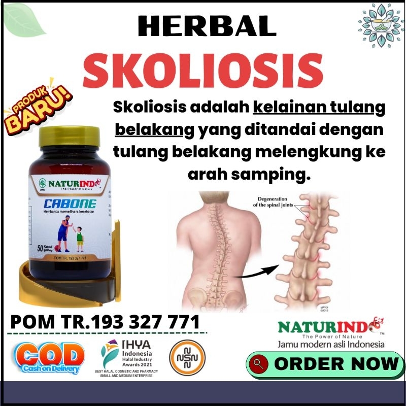 Obat Skoliosis Kelainan Tulang Belakang Kifosis Lordosis Tulang Bengkok Melengkung