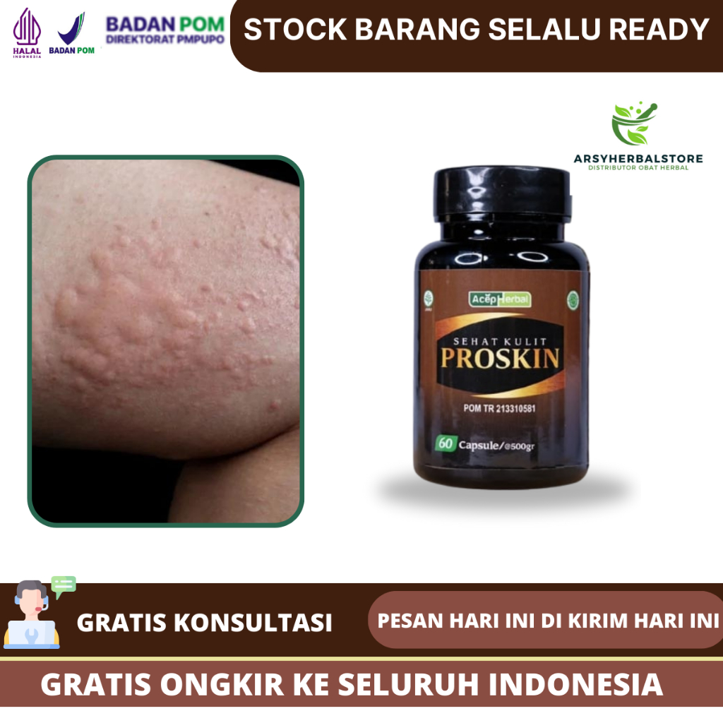 Obat Biduran , Gatal Gatal , Alergi Cuaca , Alergi Makanan , Kaligata  , Bentol Bentol Seluruh Badan