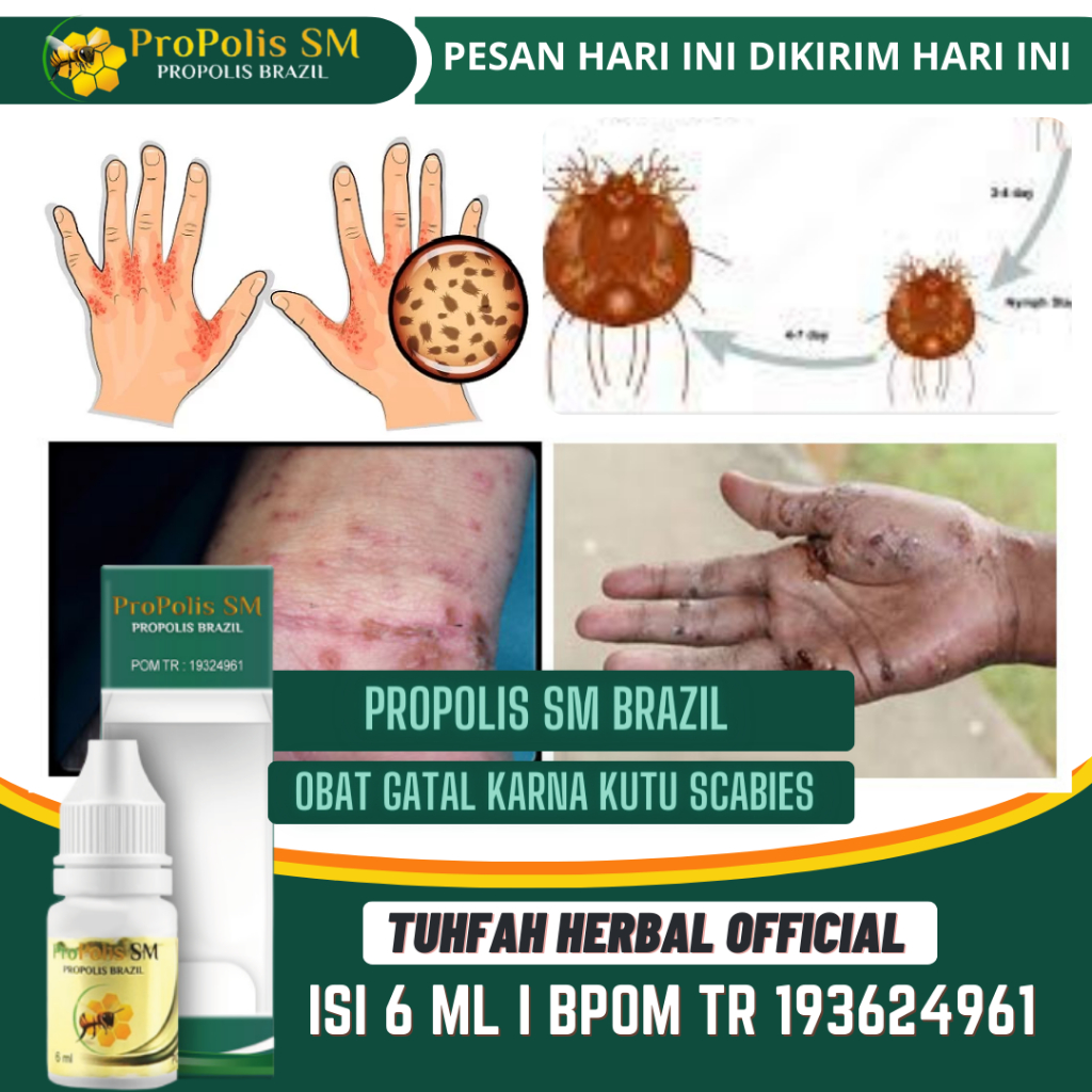 Obat Gatal Scabies, Obat Pembasmi Kudis Scabies, Obat Gatal Kulit, Obat Tetes Scabies Manusia, Obat 