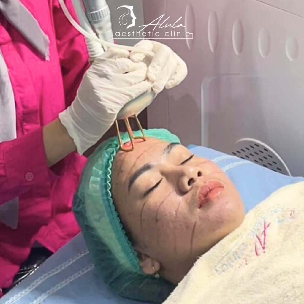 [VOUCHER] Alula Laser CO2 Fractional Treatment