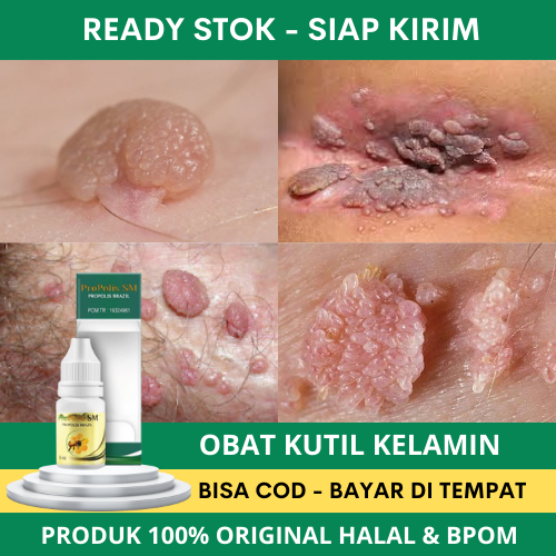 Obat Kutil Kelamin, Kutil kelamin Pria, Kutil Kelamin Wanita, Perontok Kutil Kelamin Pria Dan Wanita